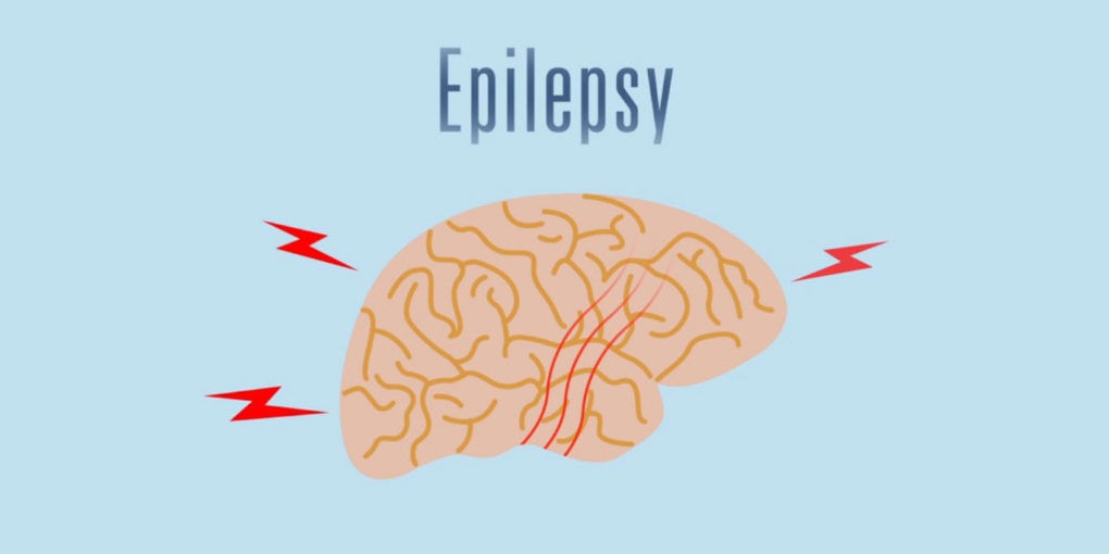 what is epilepsy seizure 1020x510 1 | Disorder